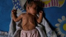 طفلة مصابة بسوء التغذية في فنزويلا (أرشيفية)